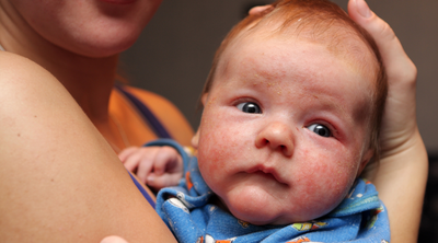 Eczema Symptoms, Causes and Remedies.